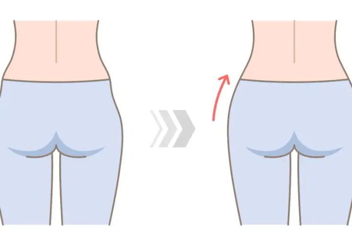 Ilustración de una mujer mostrando la reducción de los hip dips.