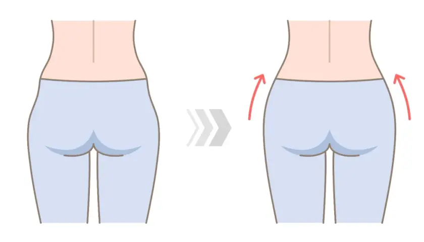 Ilustración de una mujer mostrando la reducción de los hip dips.