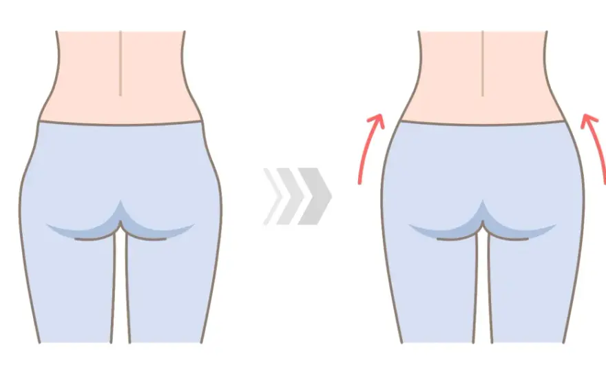 Hendiduras laterales de la cadera - ¿Defecto o anatomía normal?
