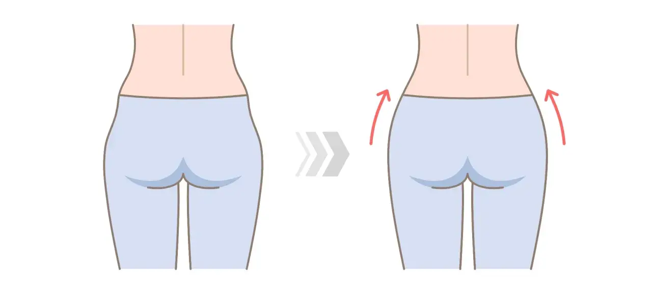 Ilustración de una mujer mostrando la reducción de los hip dips.