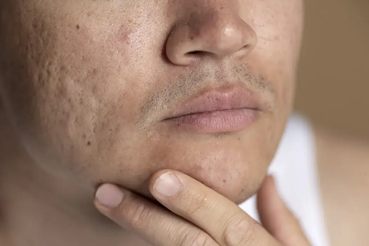 Primer plano de un rostro con cicatrices de acn&eacute; y un grano incipiente. La mano del hombre toca su barbilla, pensativo sobre c&oacute;mo explotar un grano.