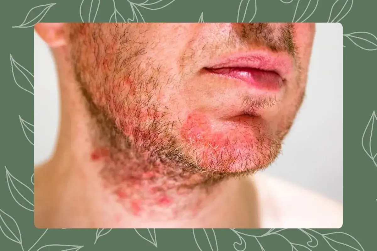 Primer plano de un hombre con granos alrededor de la boca y en la barba, mostrando irritaci&oacute;n y enrojecimiento en la piel.